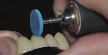 Laboratorio Dental de Goma de Diamante de Molienda Consejos Para el Pulido de Coronas de Porcelana Sin Necesidad De Reglaze o Resintering